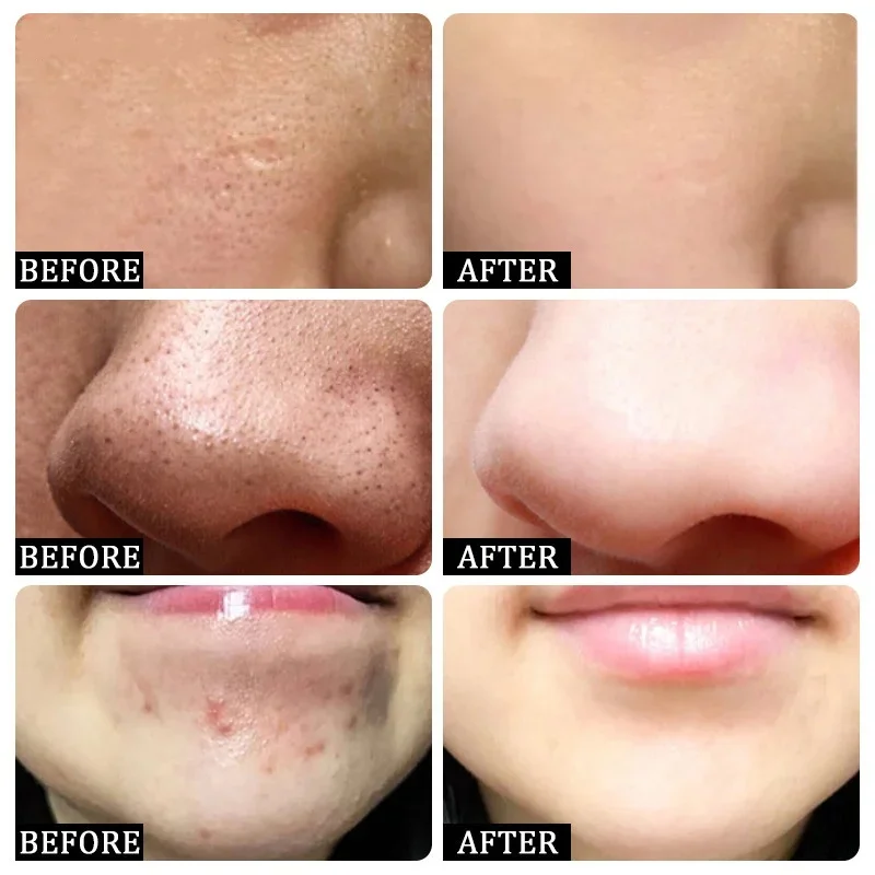 Krim Pembersih Pori Asam Salis - Korean Skincare Routine ulasan dan harga